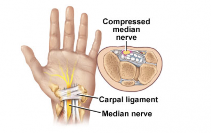 Carpal tunnel syndrome while pregnant in Dubai Carpal tunnel syndrome while pregnant in Dubai